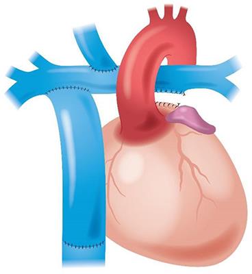 Physiological Fontan Procedure